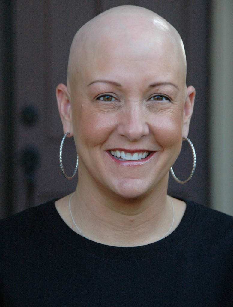 Alopecia totalis - Wikipedia